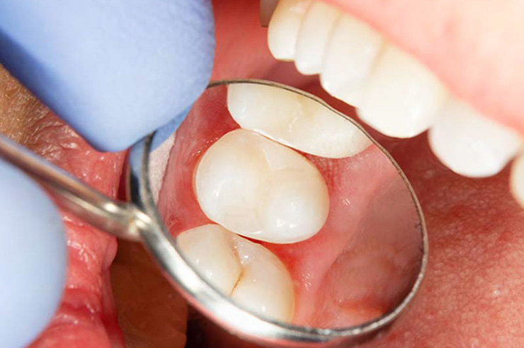 当院の親知らず治療